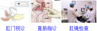 肛门检查