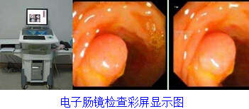 电子肠镜检查彩屏显示图