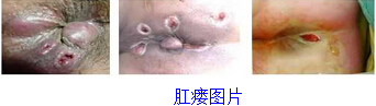 肛瘘图片