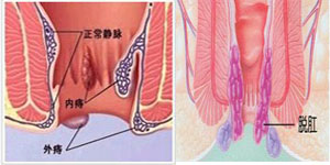 痔疮与脱肛