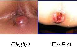 肛周脓肿-直肠息肉