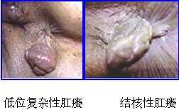 肛瘘