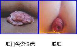 肛门尖锐湿疣-脱肛
