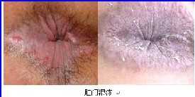 肛门湿疹