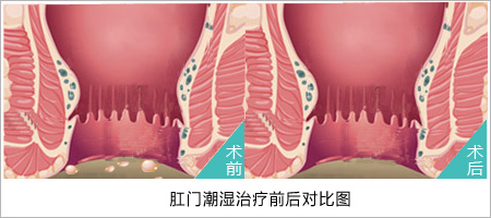 肛门潮湿