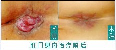 肛门息肉
