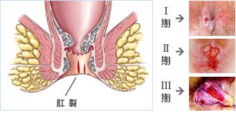 肛裂