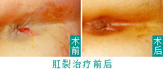 肛裂治疗前后
