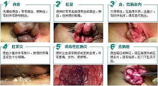 痔疮症状